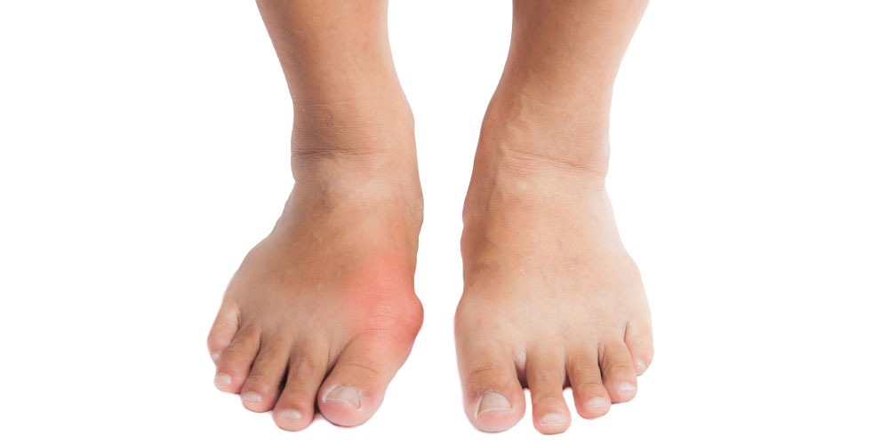Gout